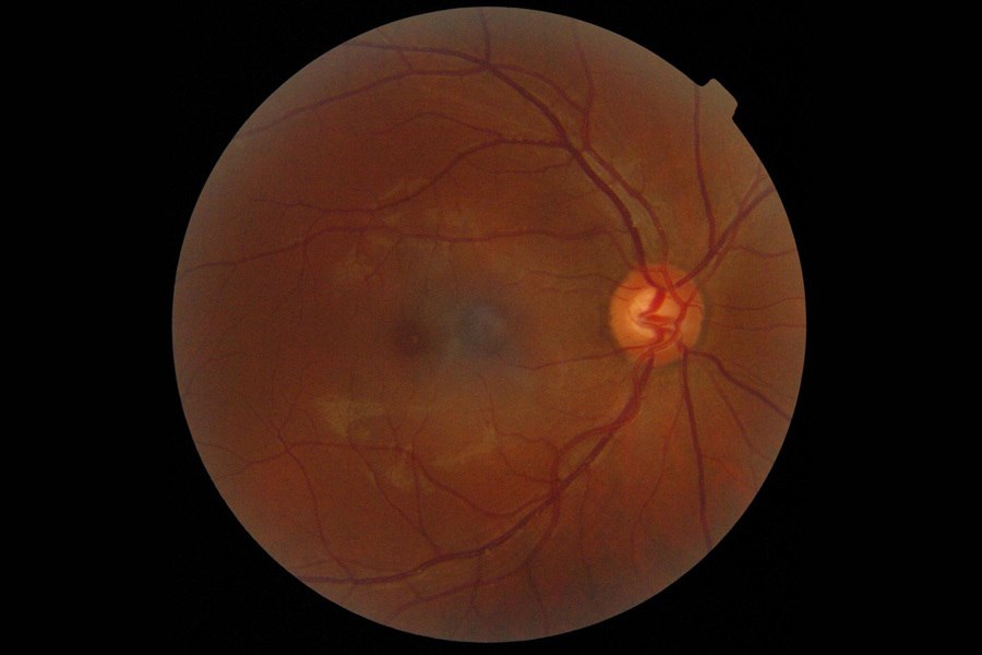 Antiangiogênicos na degeneração macular, diabetes e outras doenças da retina