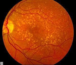 Imagem microscópica de uma olho com degeneração relacionada à idade (DMRI) seca.