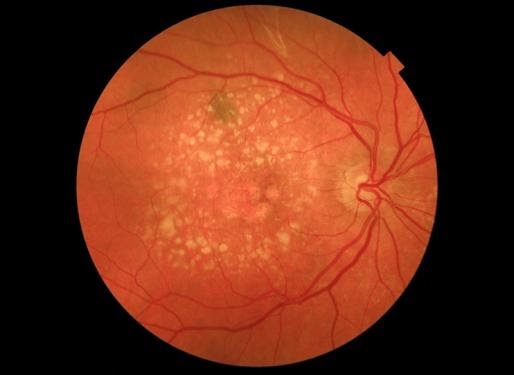 Imagem microscópica de uma olho com degeneração relacionada à idade (DMRI) úmida.